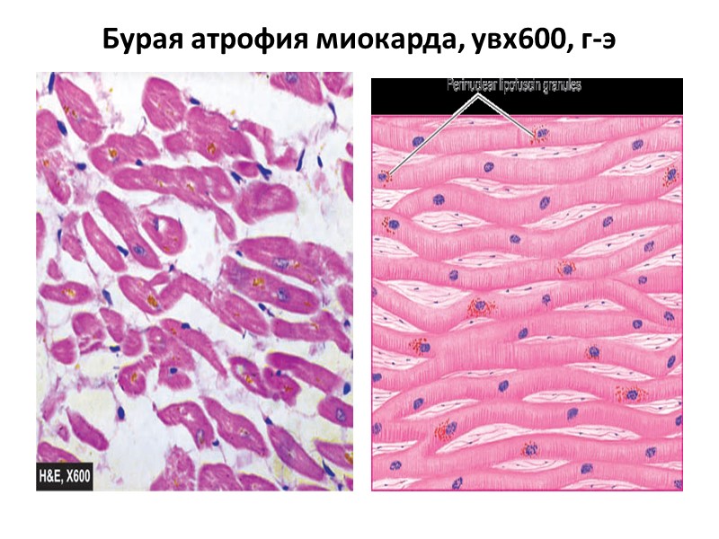 Липофусциноз. Липофусциноз миокарда патанатомия. Гипертрофия кардиомиоцитов патанатомия. Дистрофия миокарда патанатомия. Жировая дистрофия кардиомиоцитов гистология.