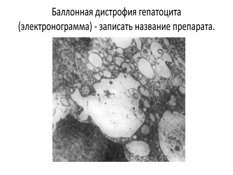 Основные элементы патогенеза нефротического синдрома Повреждение фильтра в почечных клубочках (гломерулярной базальной мембраны –
