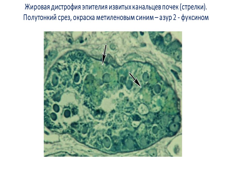 Гематоксилин-эозин Гематоксилин-эозин Судан III Судан III Стеатоз (жировая дистрофия) печени, «гусиная печень»