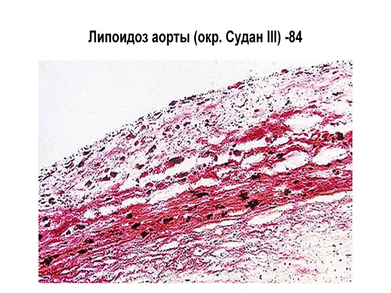 Стромально-сосудистые липидозы Атеросклероз Общее ожирение Общее истощение (кахексия)