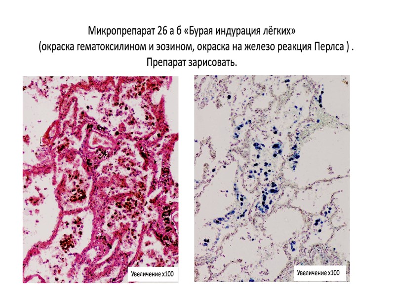 Бурая индурация легких это. Бурая индурация лёгких микропрепарат. Бурая индурация лёгкого микропрепарат. Бурая индурация легких окраска гематоксилином и эозином. Гемосидероз легкого окраска гематоксилин-эозин.