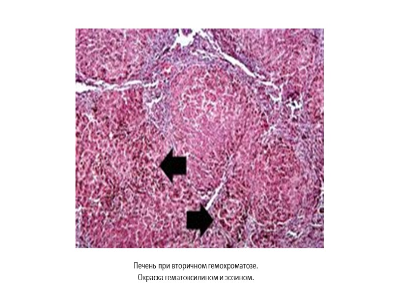 Гемохроматоз Заболевание, характеризующееся отложениями железа и атрофией паренхимы, склерозом, а также снижением функции органов