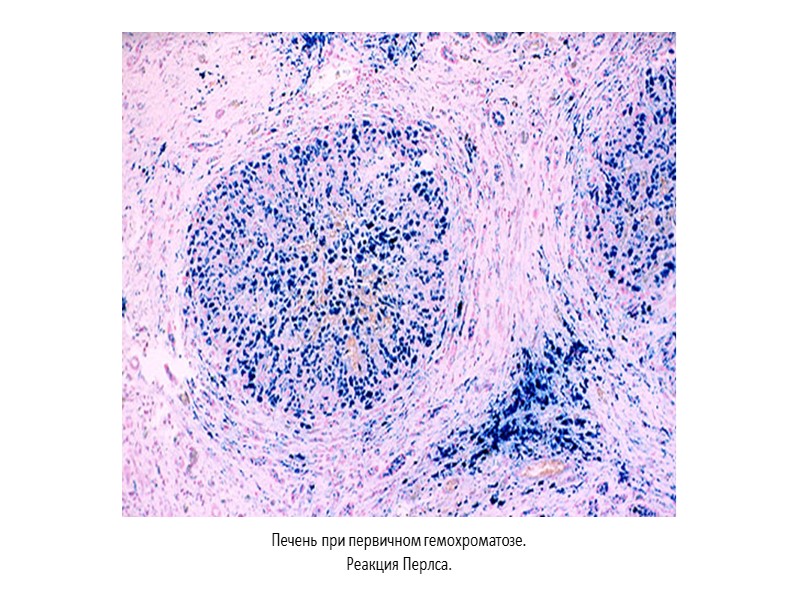 Первичный гемохроматоз -  Наследственное заболевание с аутосомно-рецессивным типом наследования, характеризующееся повышенным всасыванием железа