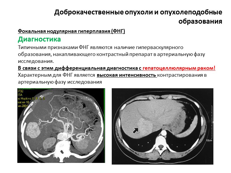 Неклассифицируемые опухоли Опухоли гемопоетической и лимфоидной ткани Метастатические опухоли Эпителиальные аномалии   