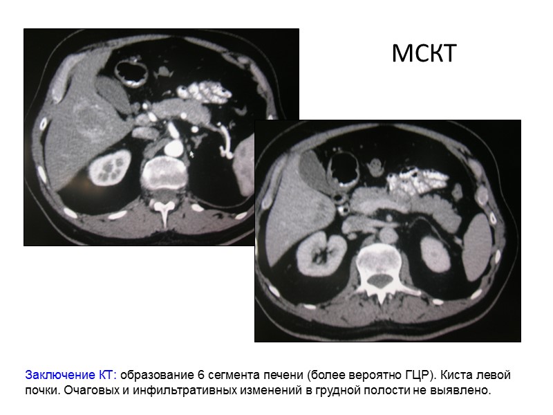 Гцр печени. Образование печени кт ГЦР. Дифференциальная диагностика образований печени на кт.