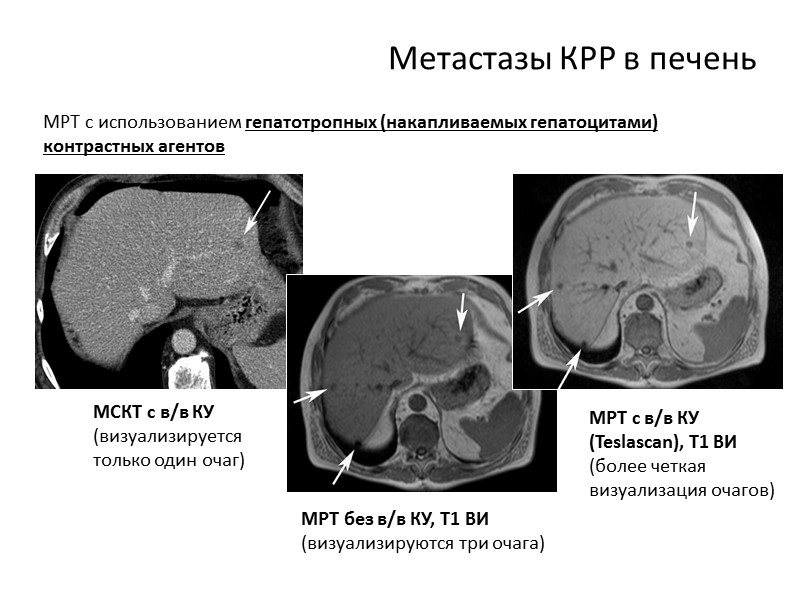 Метастазы это