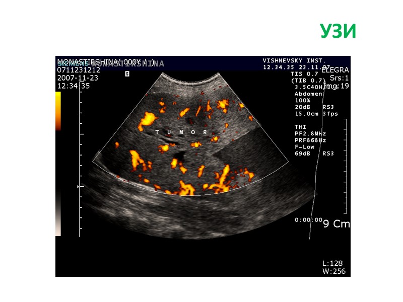 Рак на узи. Гепатоцеллюлярная карцинома УЗИ.