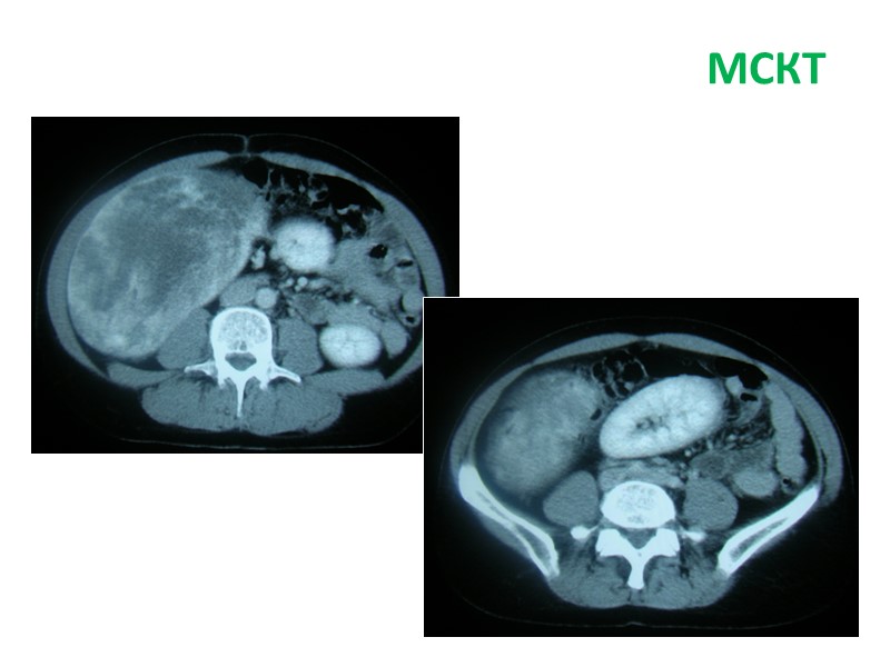 Гцр печени что это такое. Гепатоцеллюлярная карцинома кт. Гепатоцеллюлярная карцинома мрт. Гепатоцеллюлярная карцинома печени кт.