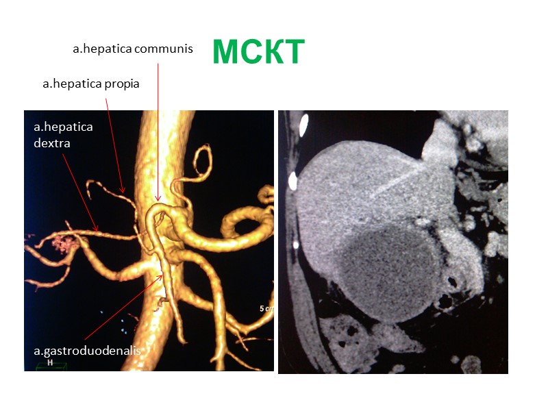 Больной Д., 54 года Диагноз: гепатоцеллюлярный рак 4 b, 5 сегмента печени. tumor
