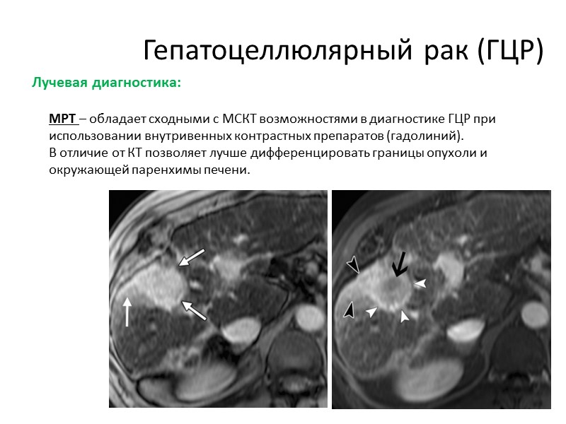 Удаление опухолей печени