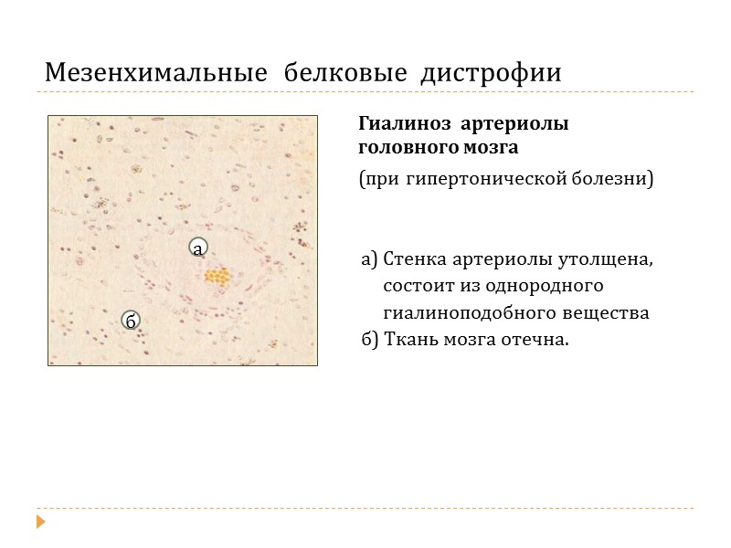 Гиалиново-капельная  дистрофия Дистрофия и некроз эпителия  почечных канальцев  (при гломерулонефрите) 