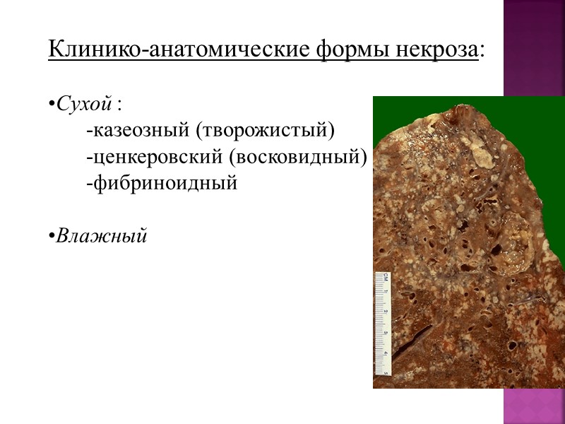 Камни почек по химическому составу:  -фосфаты  (белые, мягкие, гладкие) -ураты  