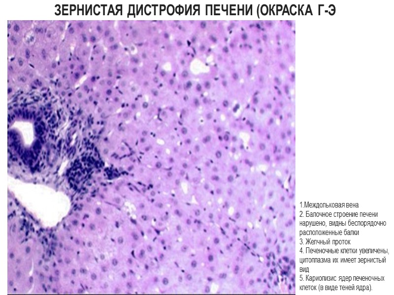 Зернистая дистрофия