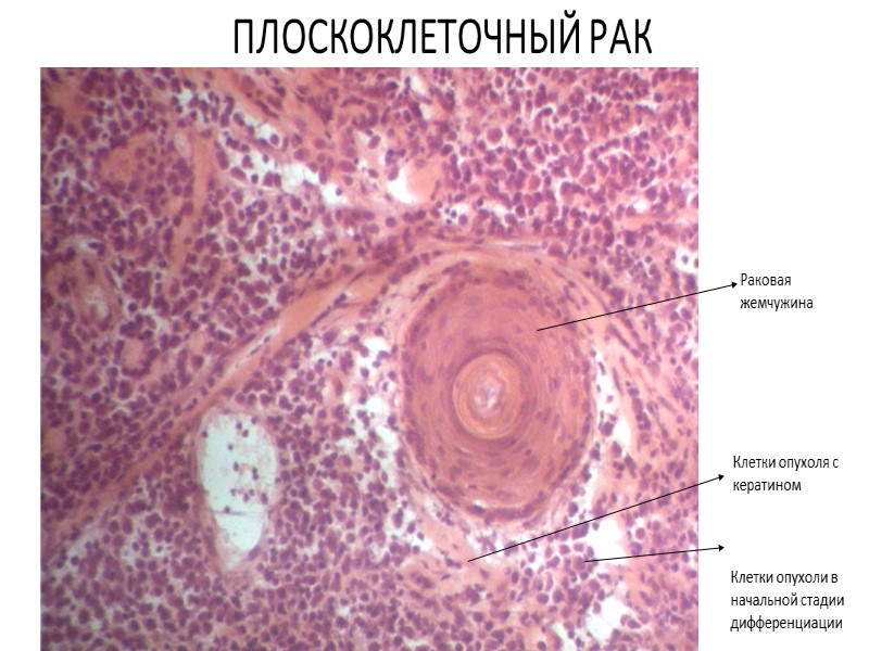 Роговая дистрофия