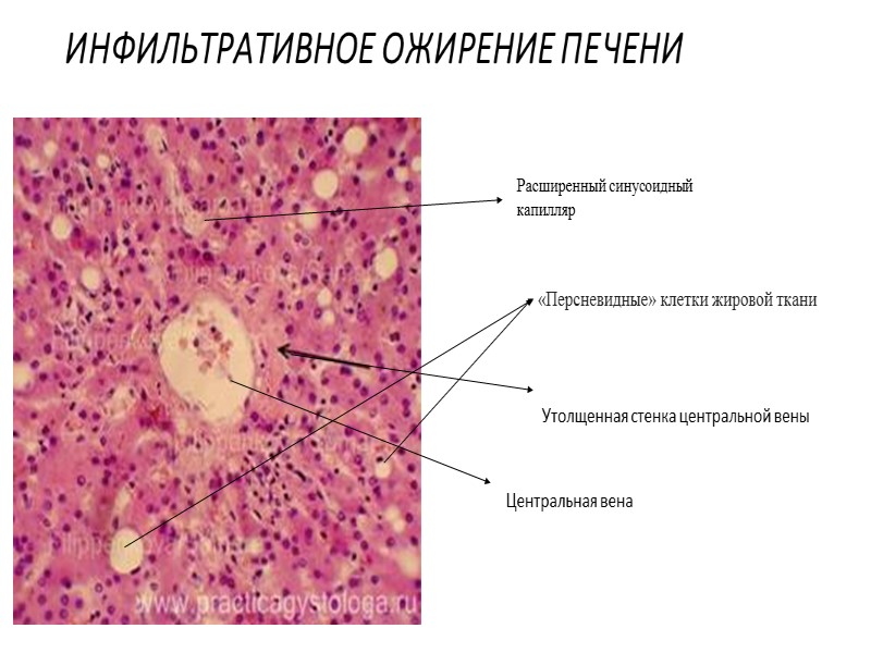 ПЛОСКОКЛЕТОЧНЫЙ РАК Раковая жемчужина Клетки опухоля с кератином Клетки опухоли в начальной стадии дифференциации