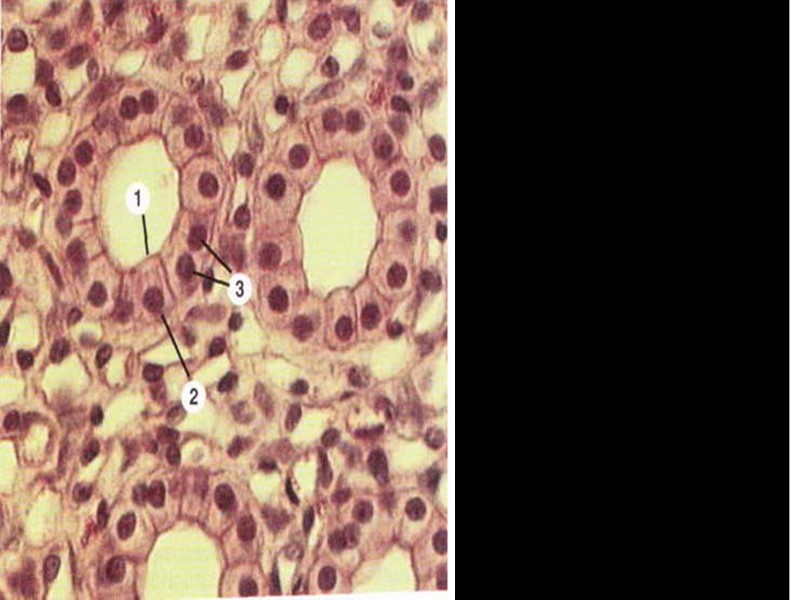 Инфильтративное ожирение почки (окраска Г-Э): Накопление жировых капель в эпителии извитых канальцев корковой зоны
