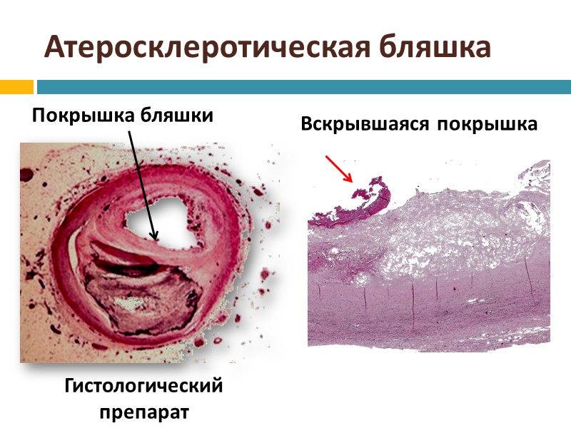 Атеросклероз Тигровое сердце Гусиная печень  Жировые дистрофии Жиры животного и растительного происхождения