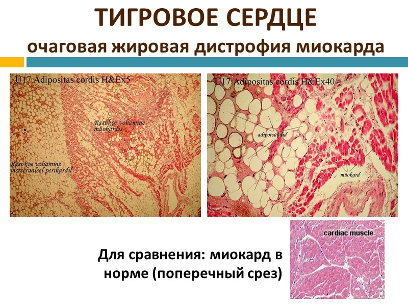 Атеросклероз аорты, стадия осложнений Самое опасное  осложнение - это разрыв покрышки (изъязвление бляшки)
