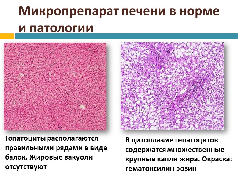 Изменения клеток печени. Жировой гепатоз гистоло. Жировой гепатоз гистология. Гидропическая дистрофия печени. Жировая дистрофия печени макропрепарат.