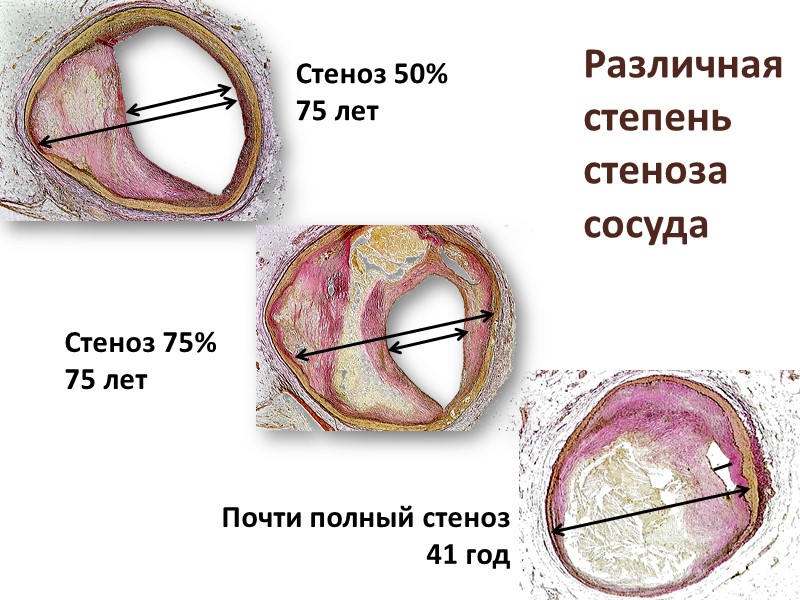 Повреждение почки при гиалинозе - гломерулосклероз Норма  Пораженная почка уменьшается в размерах, ее