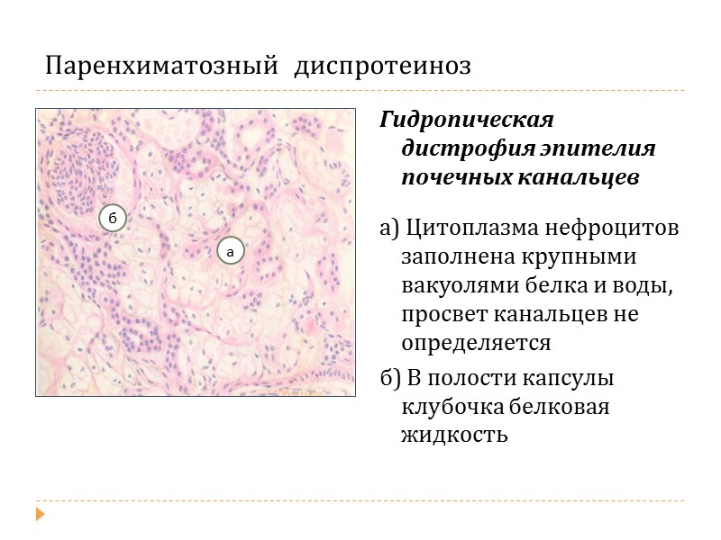 Процесс сопровождающийся накоплением в цитоплазме гепатоцитов. Гиалиново-капельная и гидропическая дистрофия эпителия канальцев. Гидропическая дегенерация. Гиалиново-капельная дистрофия эпителия канальцев почки. Гидропическая дистрофия эпителия почечных канальцев.