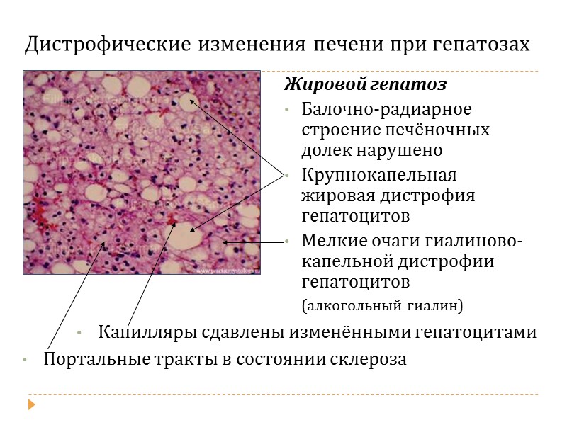 Гидропическая  дистрофия Балонная дистрофия почечных канальцев    а) Некробиоз отдельных эпителиоцитов