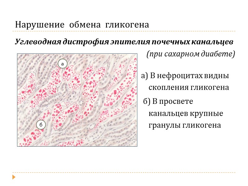Паренхиматозный  липоидоз Жировая дистрофия миокарда а) Кардиомиоциты с жировыми включениями б) Кардиомиоциты, свободные