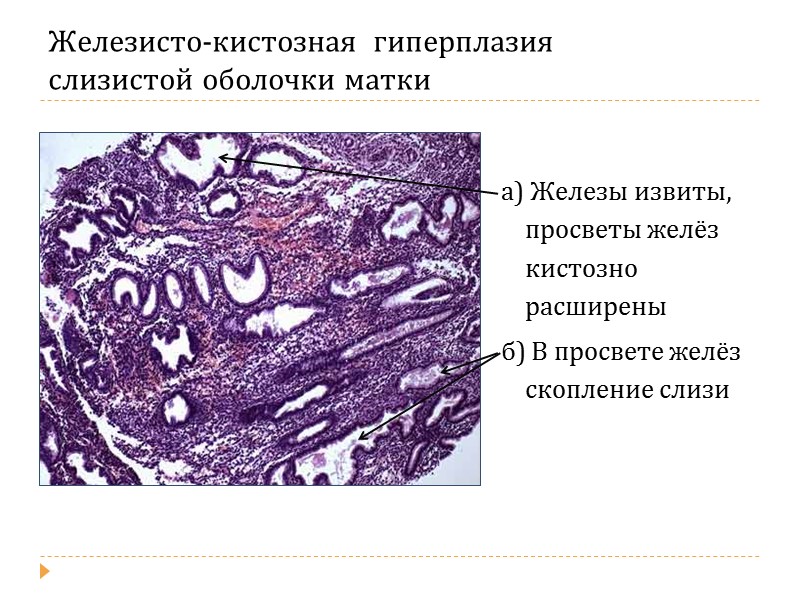 Очаговая железистая гиперплазия эндометрия. Железы слизистой оболочки матки микропрепарат. Гиперплазия эндометрия микропрепарат. Железисто-кистозная гиперплазия эндометрия микропрепарат. Железисто-кистозная гиперплазия гистология.