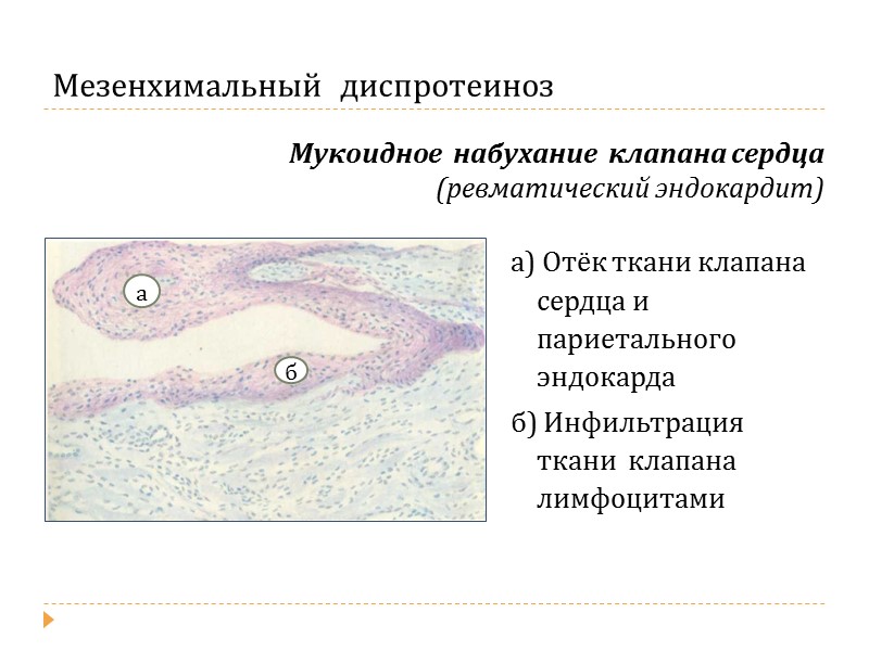 Дистрофические изменения печени при гепатозах Жировой гепатоз  Балочно-радиарное строение печёночных долек нарушено Крупнокапельная