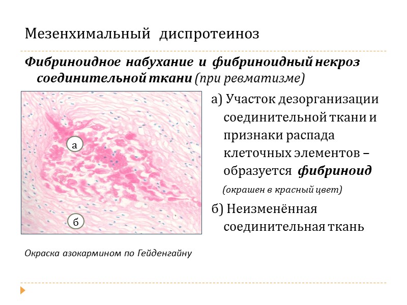 Паренхиматозный  липоидоз Жировая дистрофия эпителия почечных канальцев      