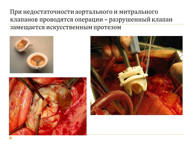Железисто-кистозная  гиперплазия   слизистой оболочки матки а) Железы извиты, просветы желёз кистозно