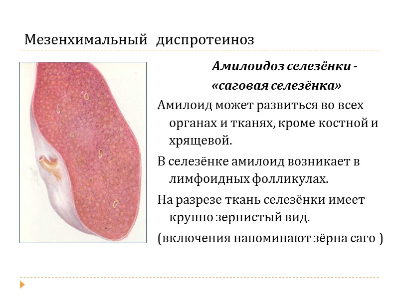 Фибриноидное  набухание  и  фибриноидный некроз соединительной ткани (при ревматизме)  Мезенхимальный