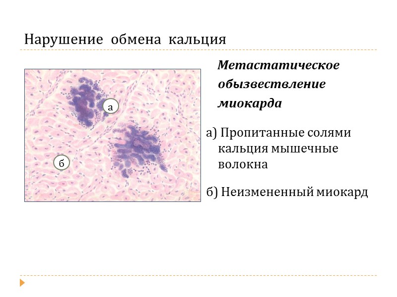 Нарушение  обмена  гемосидерина Гемосидероз лёгких  (бурая индурация лёгких)  а) В