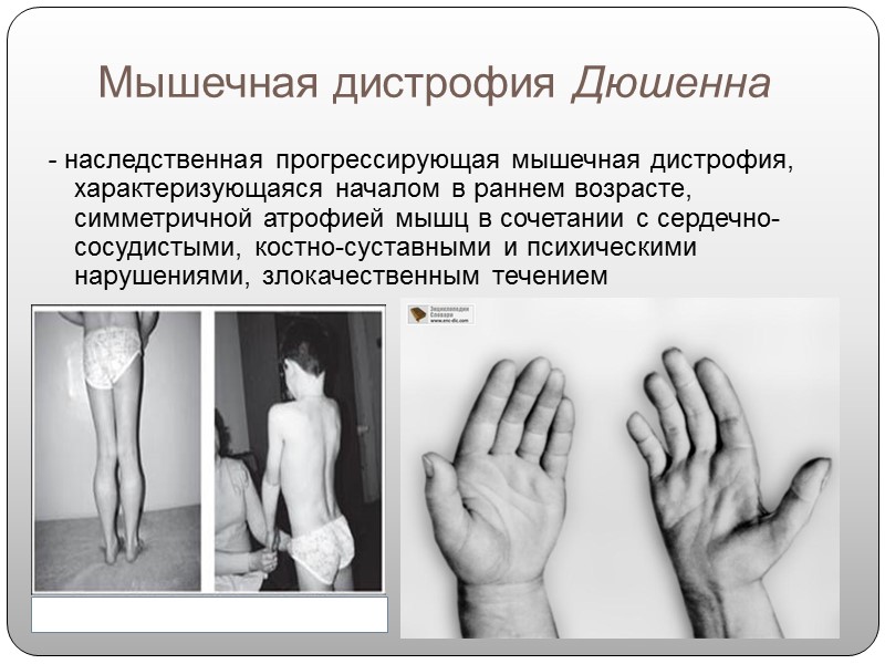 Плечелопаточная      Одним из самых ярких признаков этой разновидности мышечной