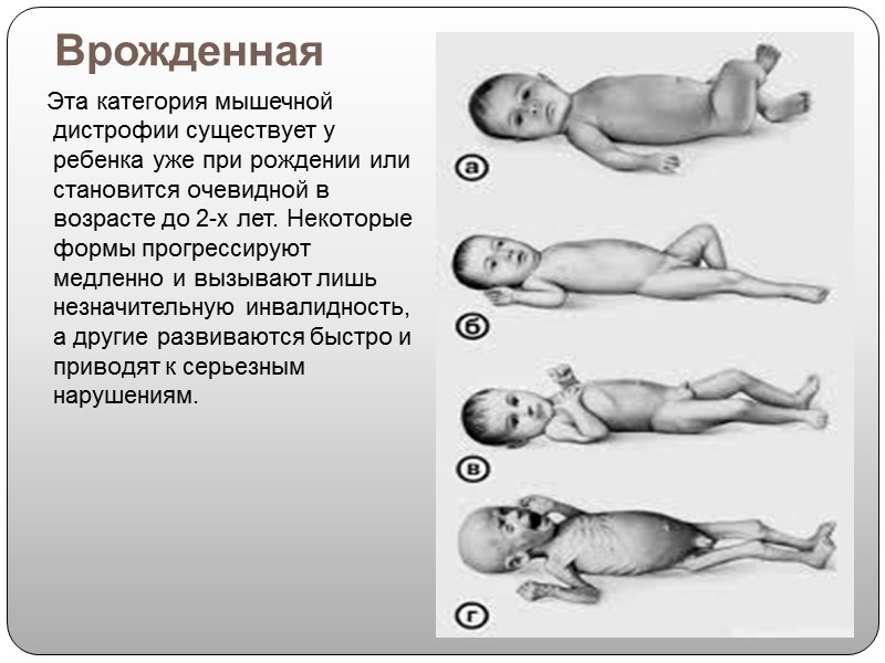 Ребенок с мышечной дистрофией Дюшенна быстро устает и испытывает трудности с поддержанием веса всего