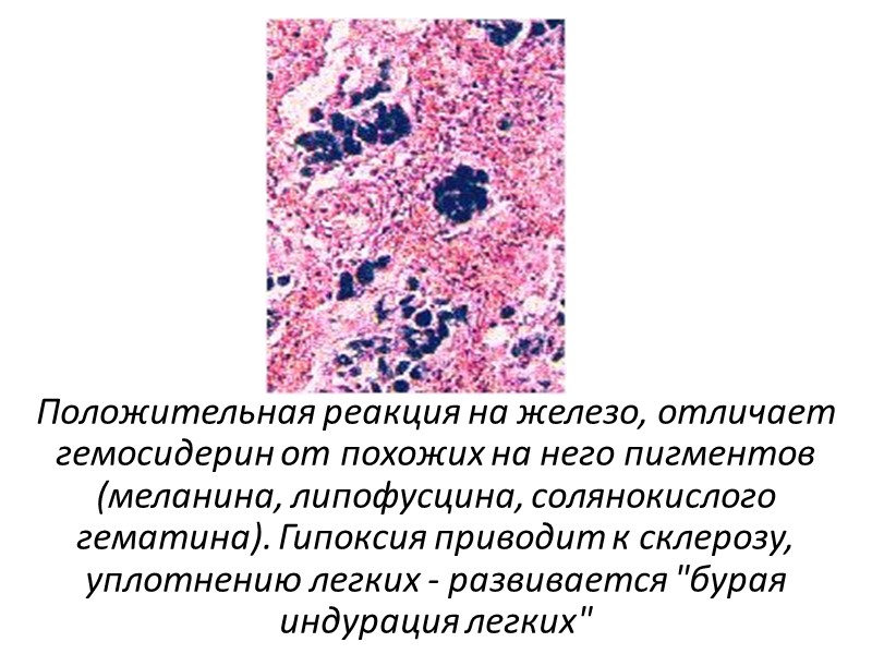 Эндогенные пигментации — разновидность смешанных дистрофий. В основе их лежат нарушения эндогенных пигментов. Эндогенные