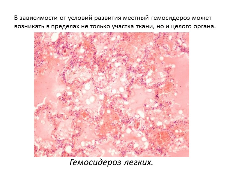 Гемохроматоз (пигментный цирроз, бронзовый диабет) Наследственное, генетически обусловленное заболевание, проявляется нарушением обмена железа с