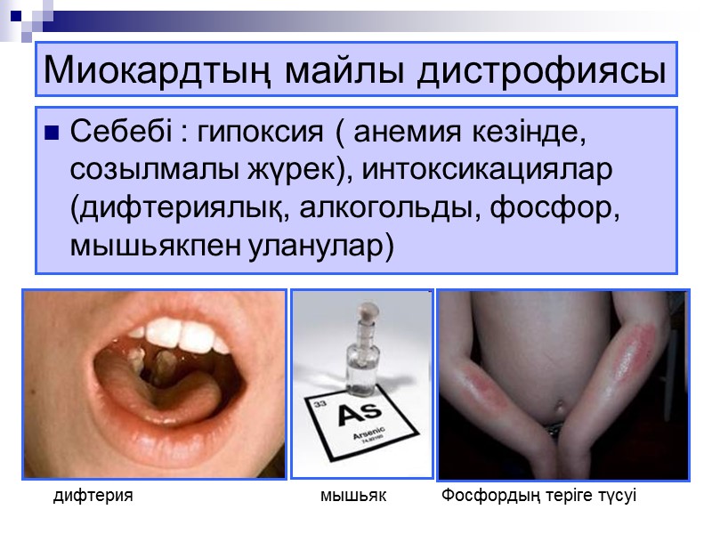 Липидтерді анықтау үшін  – судан III бояуы қолданылады. Жиі бауырда, жүректе, бүйректе дамиды