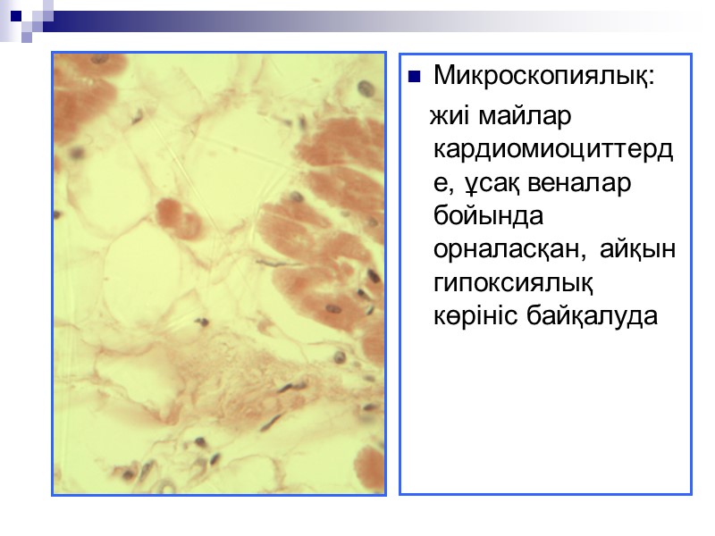 Макроскопиялық: бауыр ұлғайған, болбыр, кесіндіде сарғыш түсті май дақтарымен Микроскопиялық: гепатоцит  цитоплазмасында вакуолдер