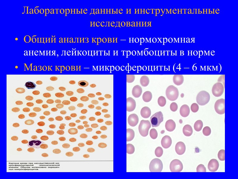 Гемолитическая анемия картина крови