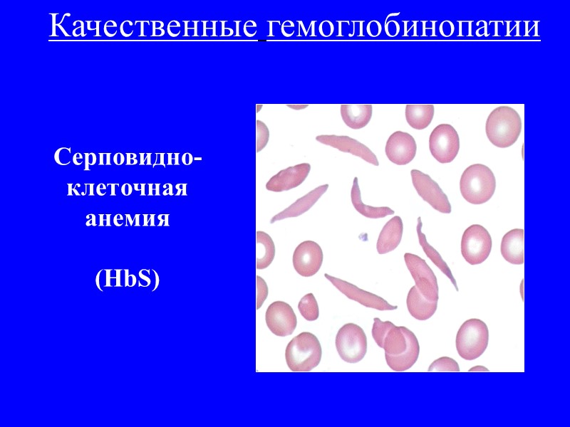 Наследственные гемолитические анемии, связанные с нарушением структуры или синтеза гемоглобина (гемоглобинопатии)  Талассемии (количественные