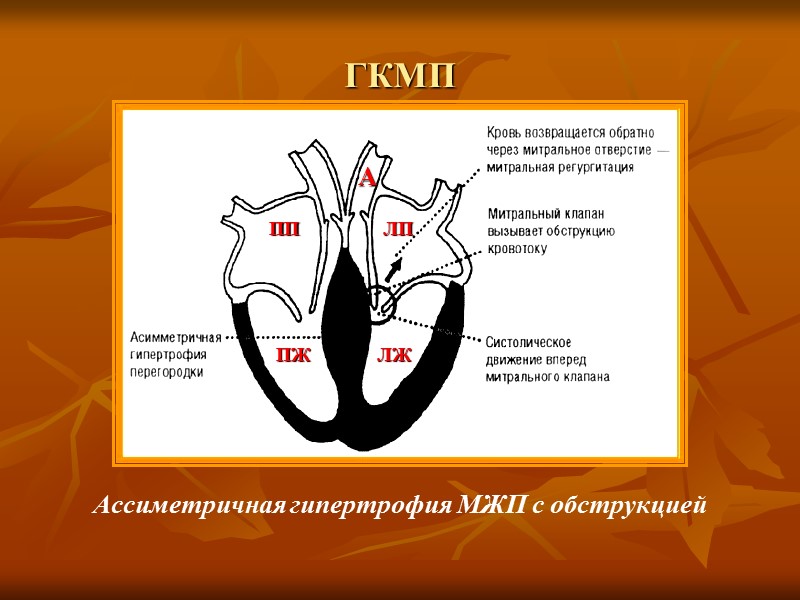 ДКМП Характерный структурный признак - значительная дилатация всех камер сердца (больше ЛЖ) при неизменённой