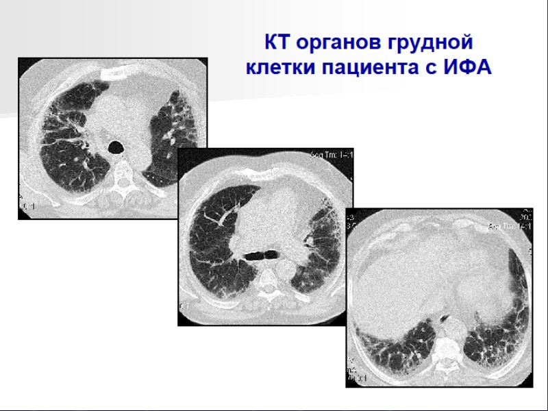 Синдром Гудпасчера  иммуновоспалительное заболевание мелких сосудов легких и почек  Этиология неизвестна 