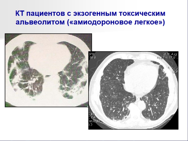 Какая рентгенологическая картина характерна для альвеолитов