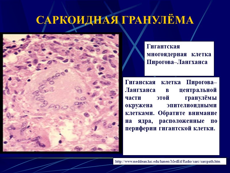 Туберкулезная гранулема картинки