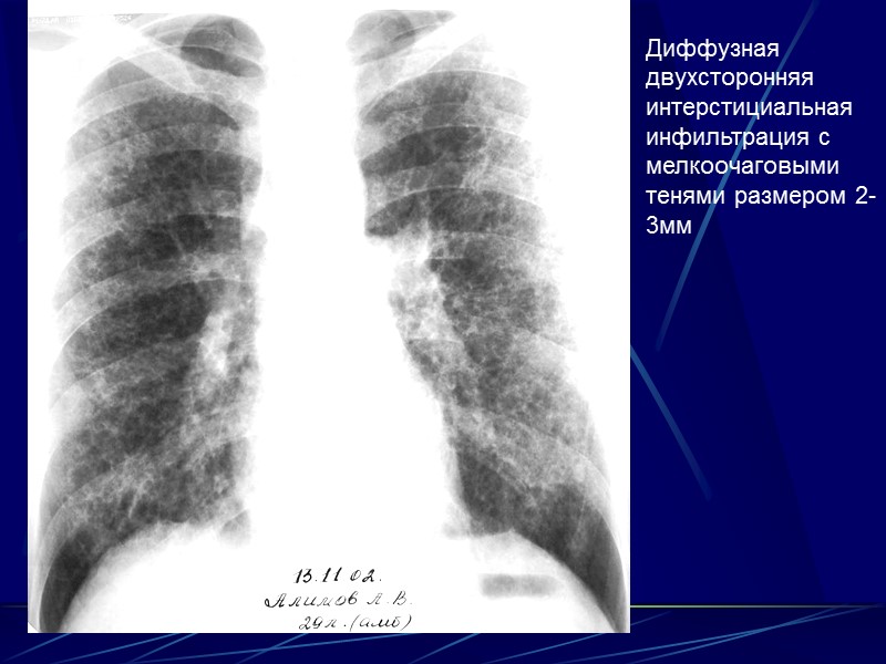 Рентгенологические симптомы   двухстороннее симметричное поражение   прикорневые уплотнения веерообразно расходящиеся от