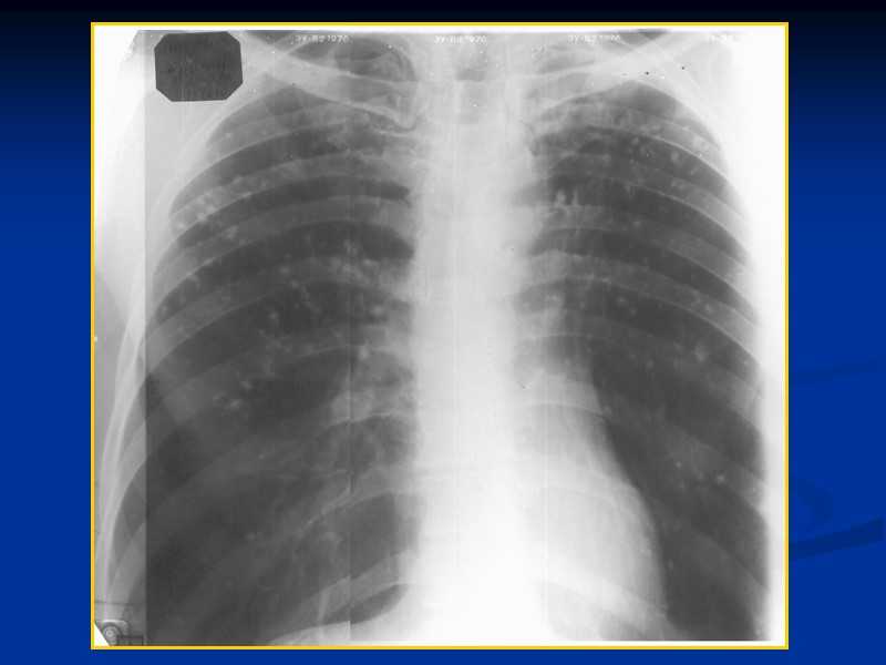 98 Заболевания, сопровождающиеся  синдромом обширной очаговой диссеминации:   Диссеминированный туберкулез  Саркоидоз