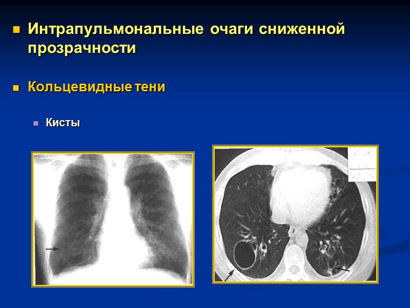 Процессы, сопровождающиеся картиной воздушной полости:   Истинные и ложные кисты  Кистозная гипоплазия