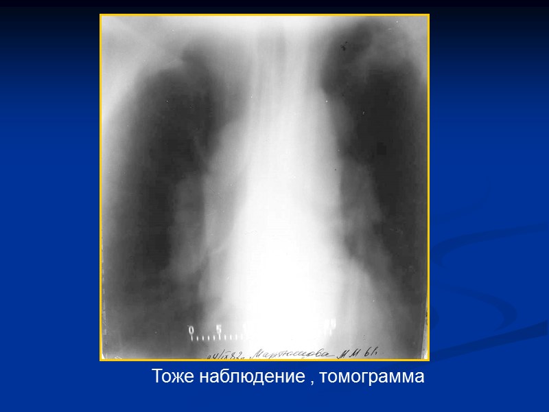 ДИССЕМИНАЦИЯ ПРИЧИНЫ:  диссеминированный туберкулез легких - пневмония при сепсисе   метастазы -