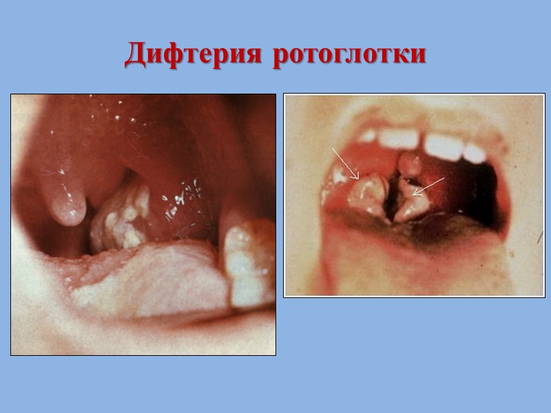 Патогенез дифтерии Проникновение через слизистые зева, носа, гортани, реже – глаз, половых путей, редко